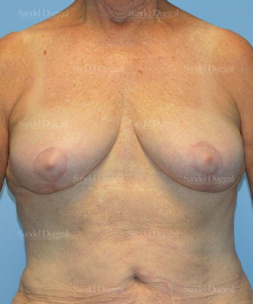 Breast Lift after, case 3315