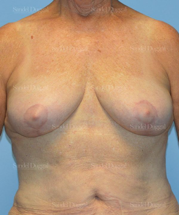 Breast Lift after, case 3315