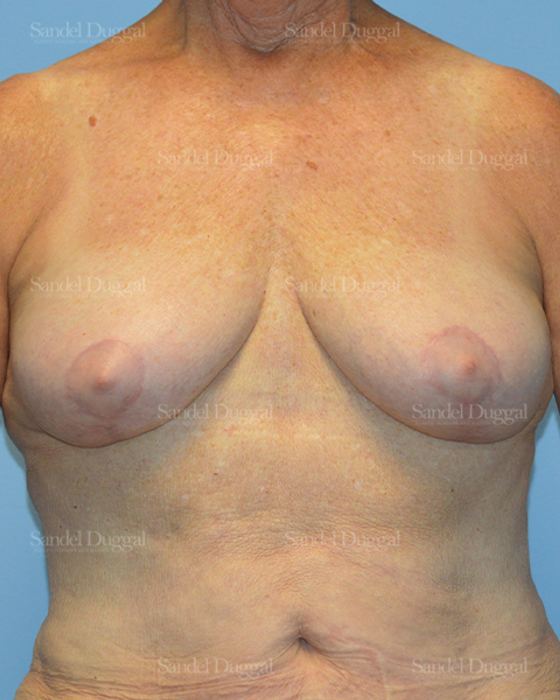 Breast Lift after, case 3315