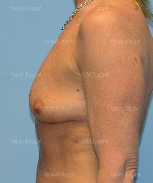 Breast Augmentation with Lift before, case 3386