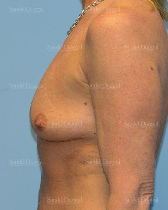 Breast Augmentation with Lift before, case 3386