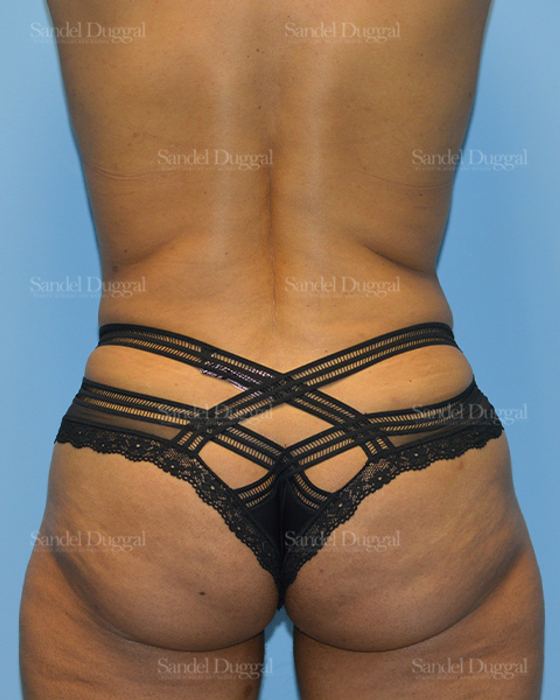 Tummy Tuck after, case 1510