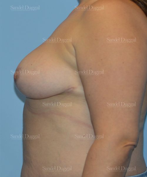 Breast Lift after, case 3280