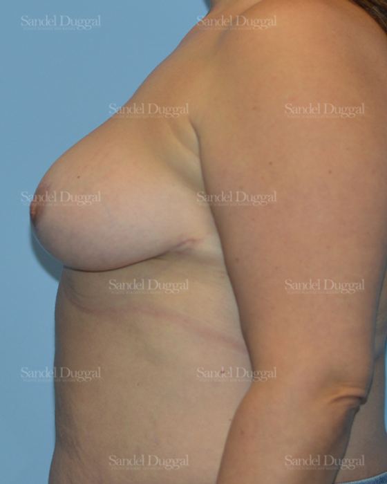 Breast Lift after, case 3280