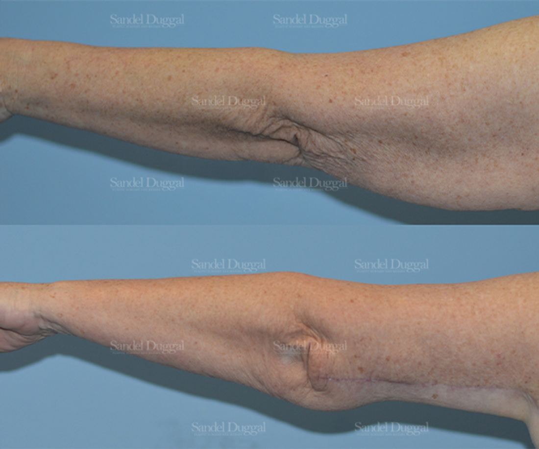 Brachioplasty before and after, case 2113