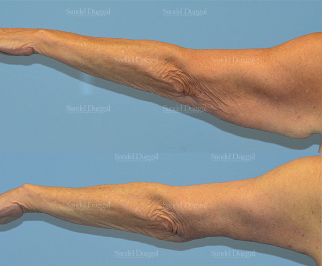 Brachioplasty before and after, case 2144