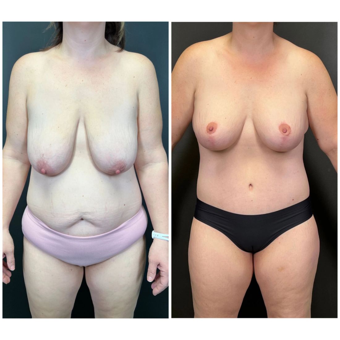 Mommy Makeover before and after, case mommy-makeover-06