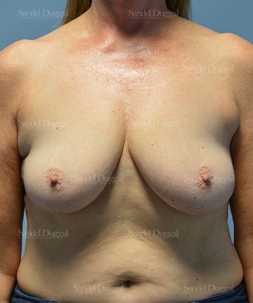Breast Augmentation with Lift before, case 3372