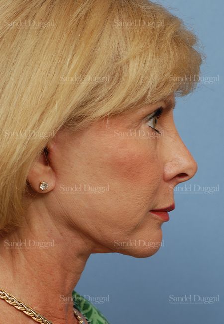 Facelift after, case 2666