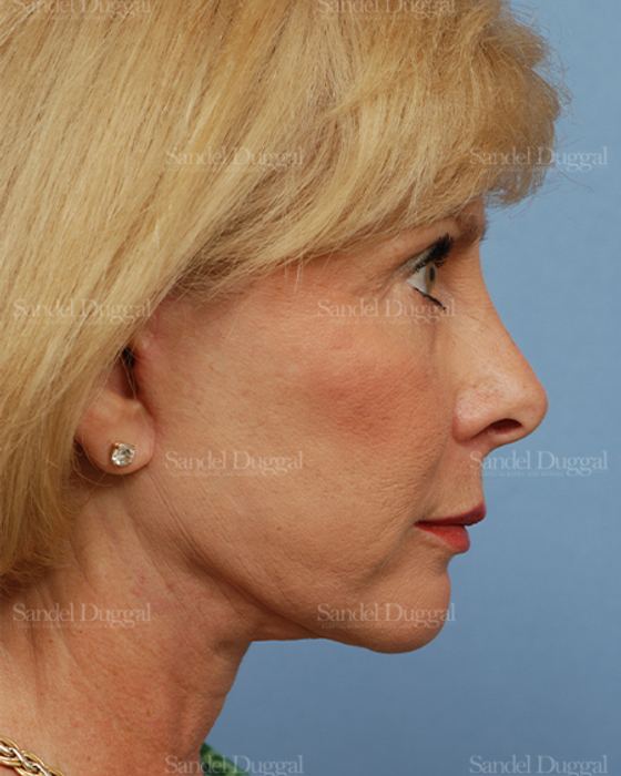 Facelift after, case 2666