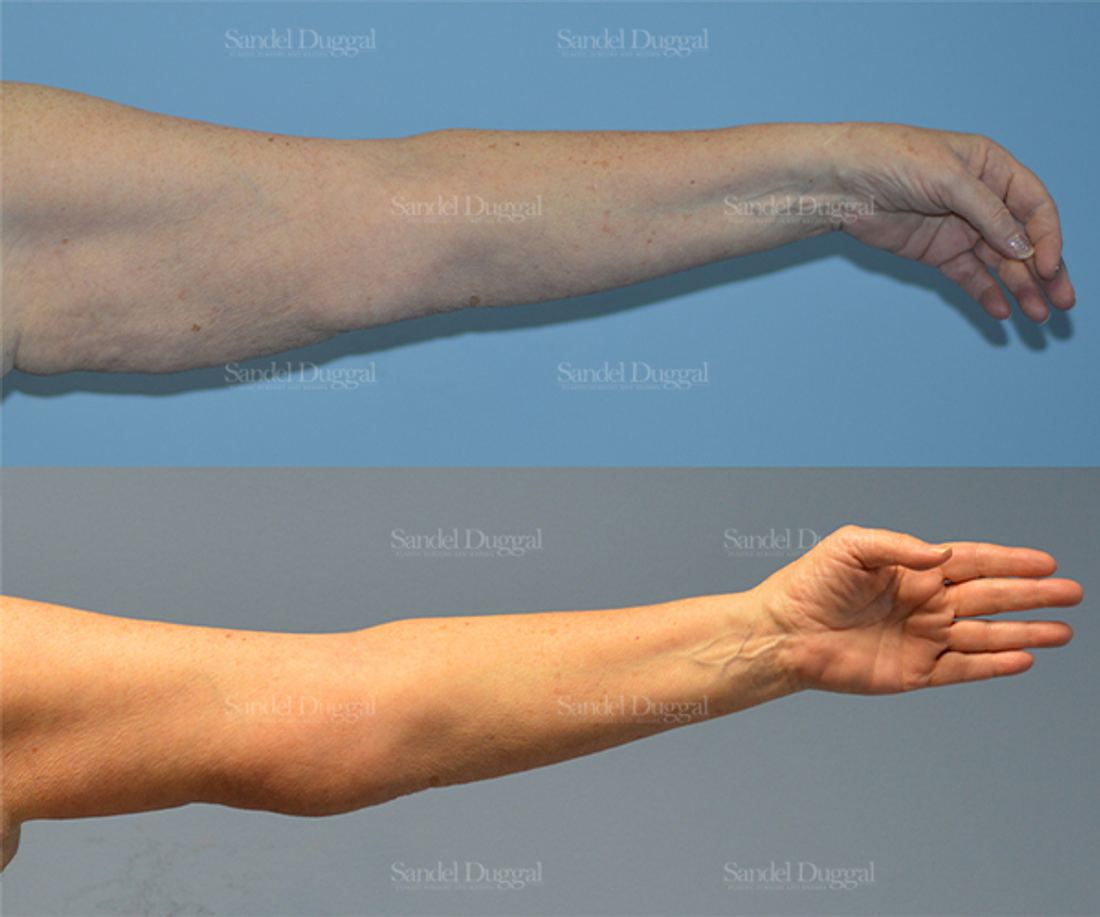 Brachioplasty before and after, case 2113