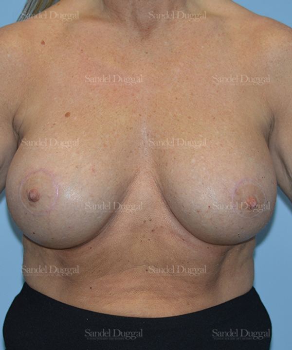 Breast Augmentation with Lift after, case 3386