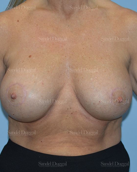 Breast Augmentation with Lift after, case 3386