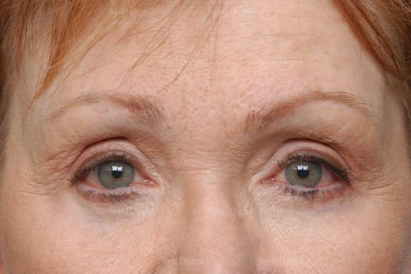 Eyelid Rejuvenation after, case 1930