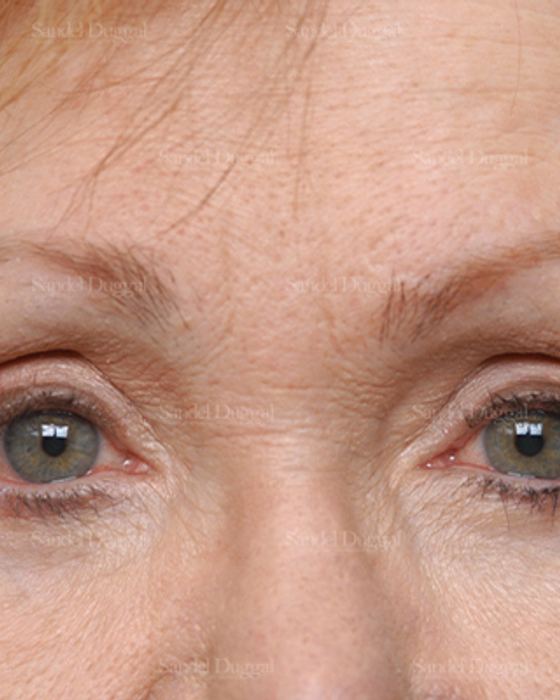 Eyelid Rejuvenation after, case 1930