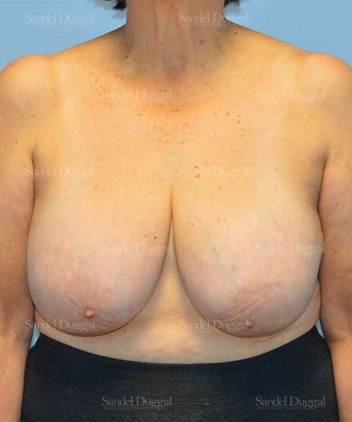 Breast Lift before, case 3287