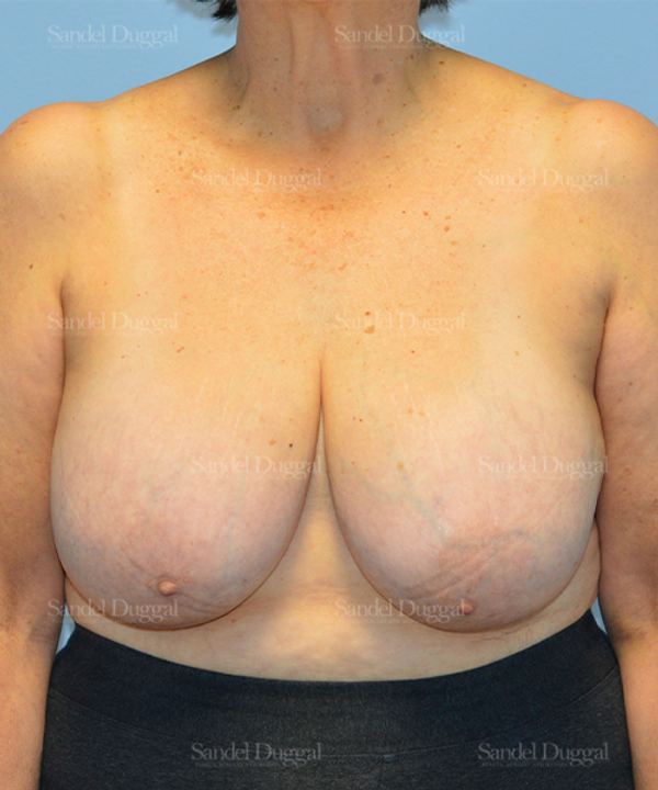 Breast Lift before, case 3287