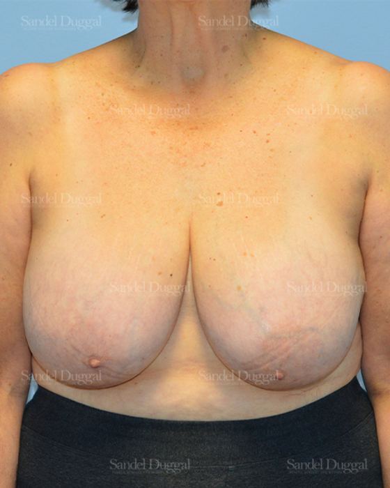Breast Lift before, case 3287