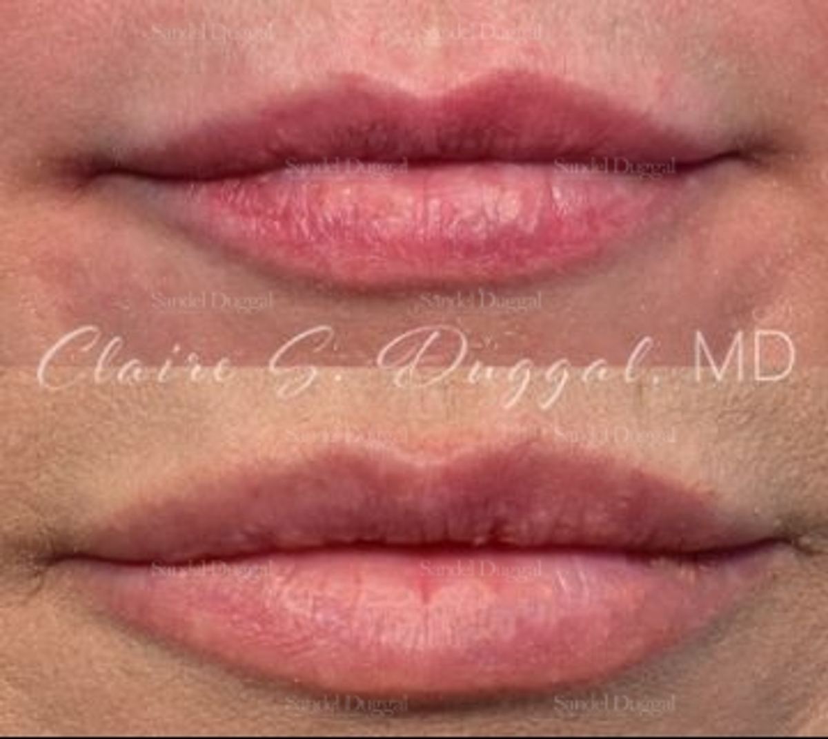 Lip Augmentation / Lip Lift before and after, case 4354
