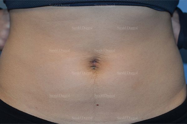Umbilicoplasty after, case 1462