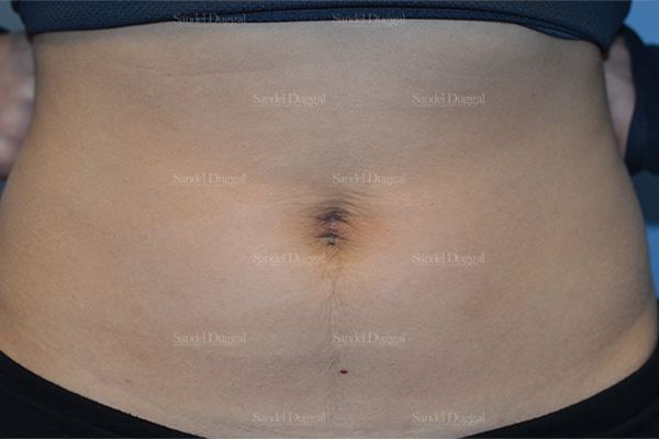 Umbilicoplasty after, case 1462
