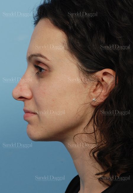 Rhinoplasty after, case 2831