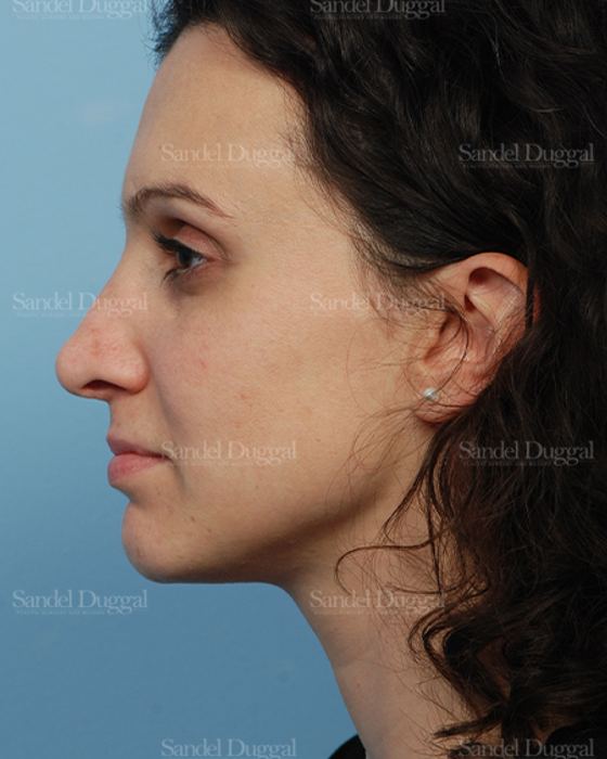Rhinoplasty after, case 2831