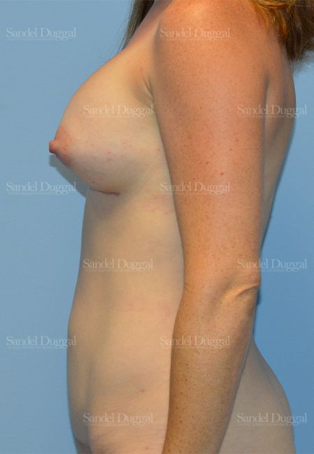 Mommy Makeover after, case 792