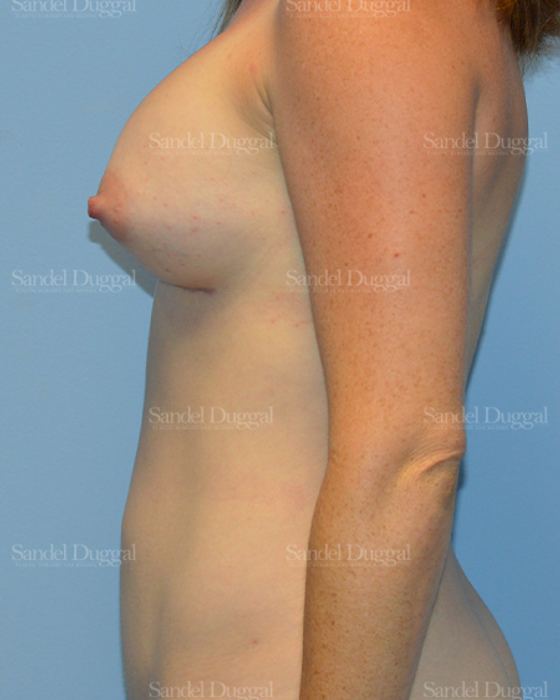 Mommy Makeover after, case 792