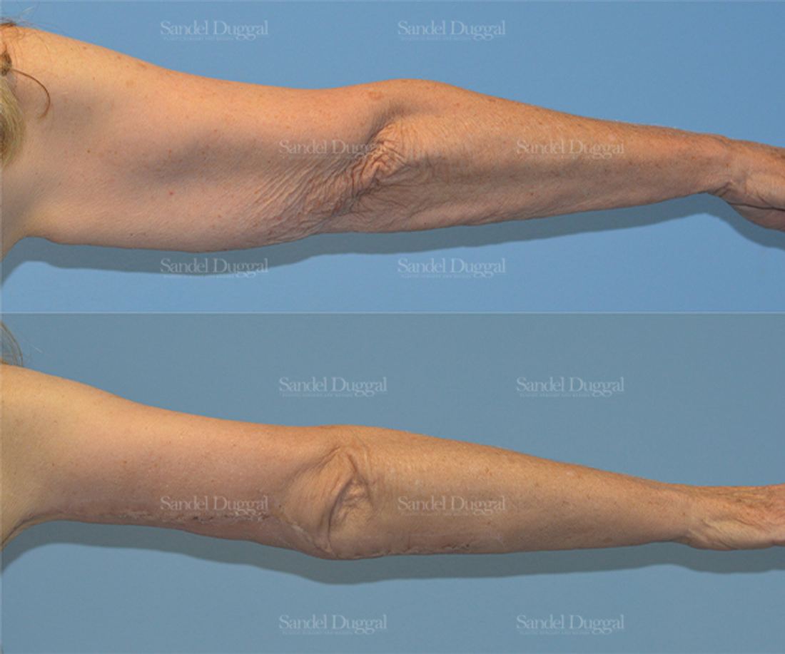 Brachioplasty before and after, case 2118