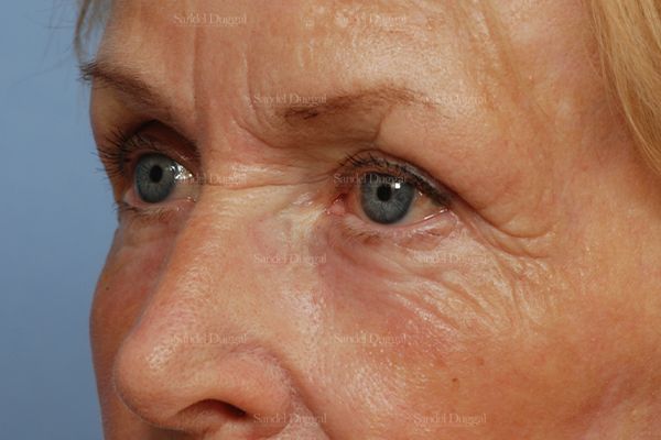 Eyelid Rejuvenation after, case 1951