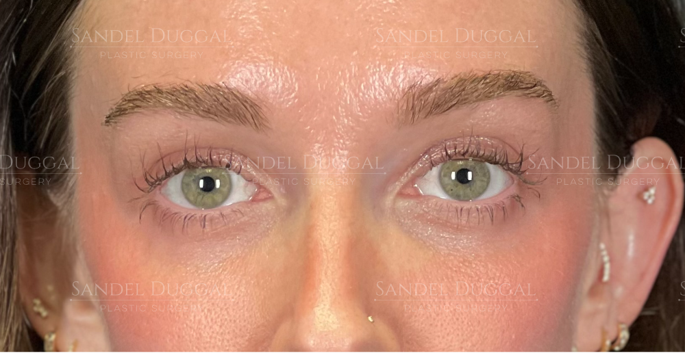 Eyelid Rejuvenation after, case 6001
