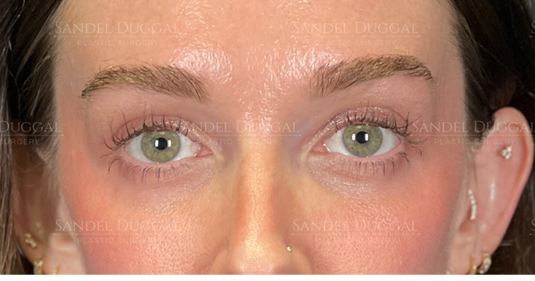 Eyelid Rejuvenation after, case 6001