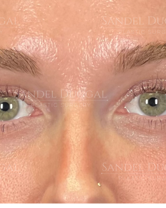 Eyelid Rejuvenation after, case 6001