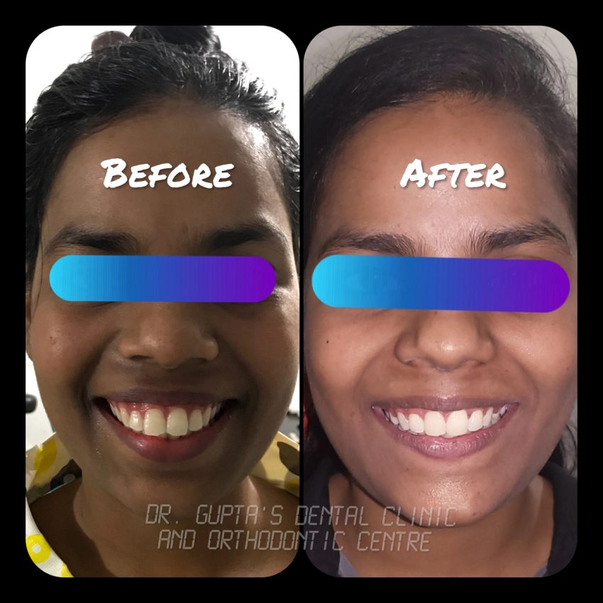 Paired patient smile photographs from Gupta Dental
