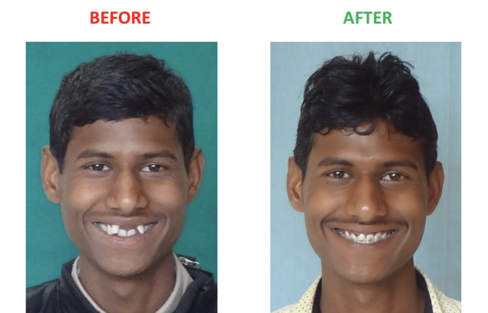 Clinical photograph from Gupta Dental’s smile gallery 1
