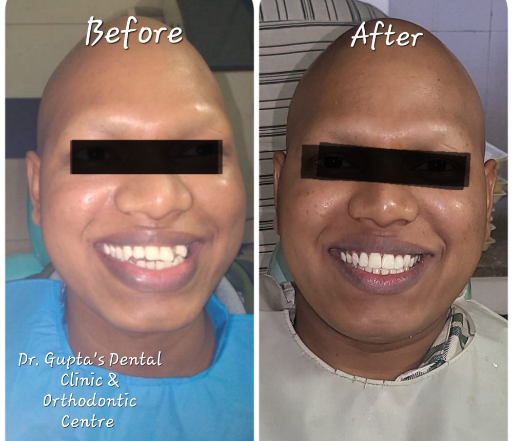 Clinical photograph from Gupta Dental’s smile gallery 3