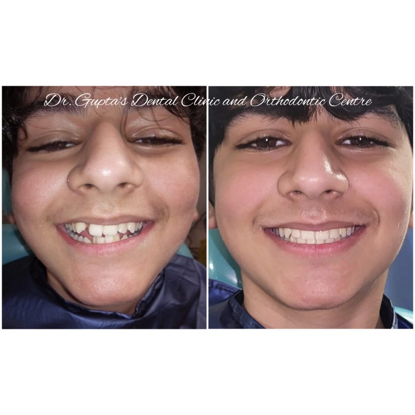 Paired close-up portraits of a patient’s smile