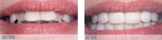 Before offwhite and unpolished teeth, after white evenly straight teeth