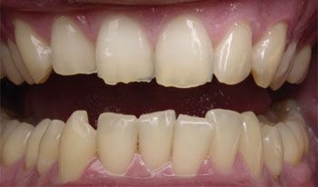 Signs of occlusal damage