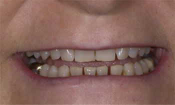 Evidence of flat canine teeth