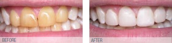 Before of yellowed teeth, after whitened teeth
