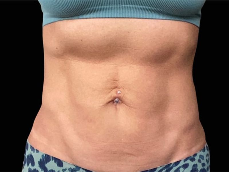 Mature woman abs Mature woman abs After Emsculpt NEO Body Contouring fat removal therapy in Montreal