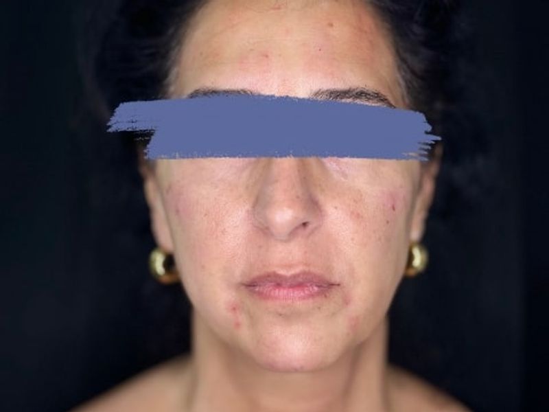After Female Cheeks and Marionette Lines Dermal Fillers procedure at our Montreal aesthetic clinic