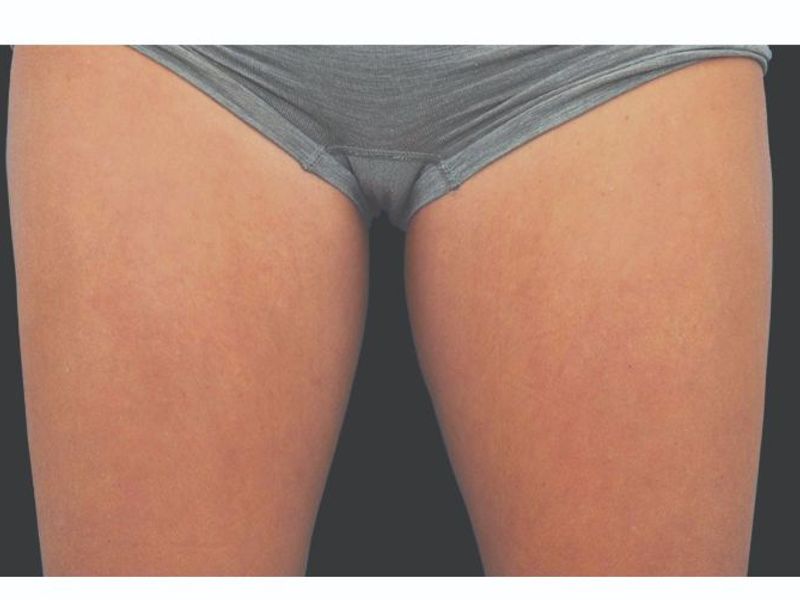 Thighs After CoolSculpting Body Contouring fat loss Treatment in Montreal
