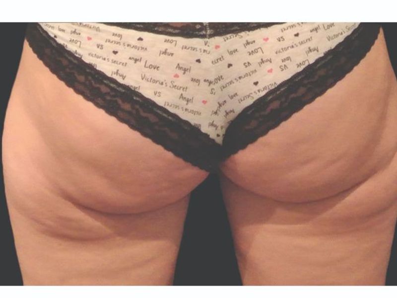 Cellulite buttocks and thighs Before CoolSculpting Body Contouring fat loss Treatment in Montreal