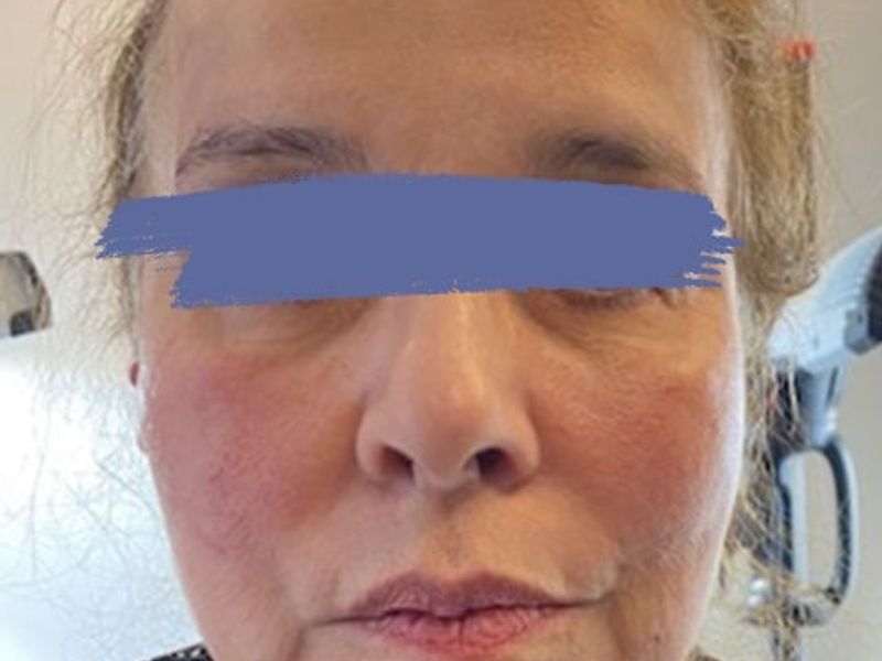 Female jaw and eyebrow before PDO thread lift procedure at our Montreal, Quebec aesthetic clinic