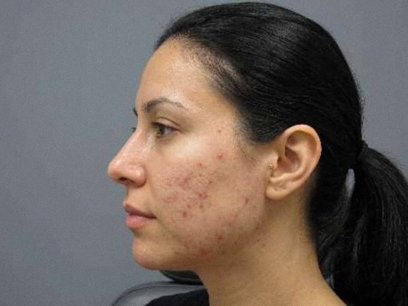 Illustration: side profile of a woman with red blemishes and uneven texture across her cheek and jaw.