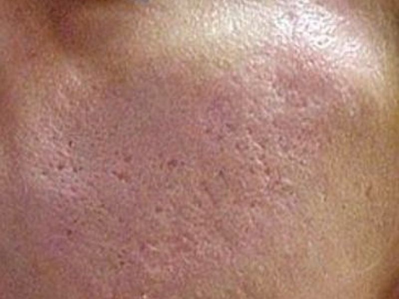 Acne Fotona Laser Skin Treatment for acne and acne scars - Montreal