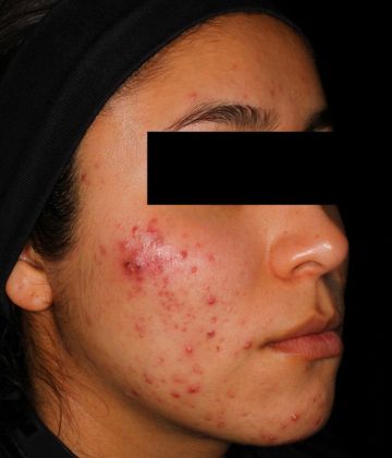 Before laser acne treatment in Montreal